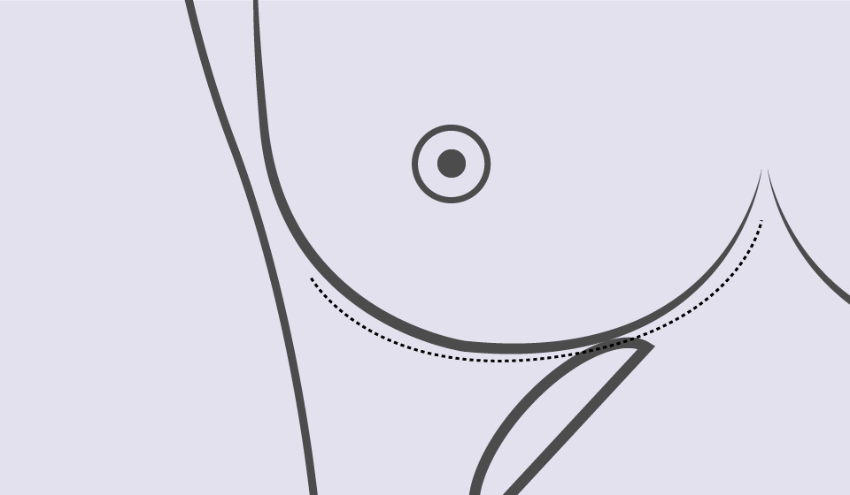 Mastectomía  Radical Modificada