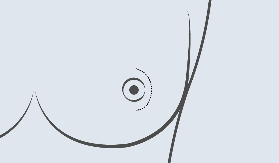 Resección de  Conductos Terminales