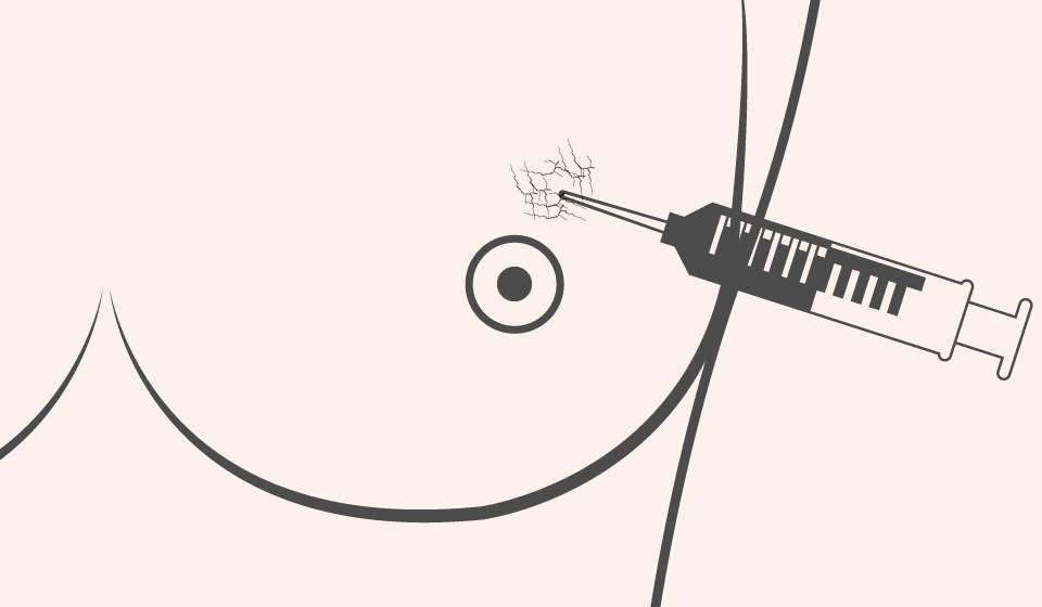 Técnica de Ganglio Centinela