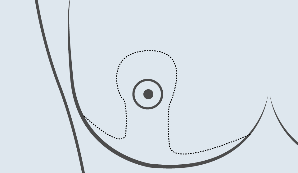 Técnicas de  Cirugía Oncoplástica